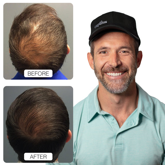 Capillus Spectrum MD (New)