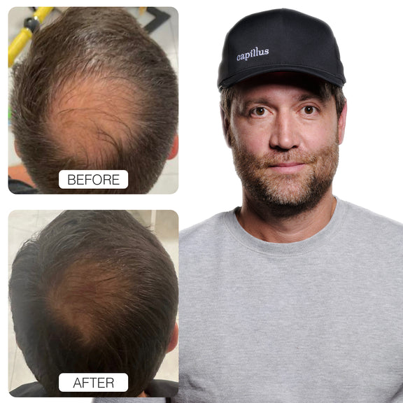 Capillus Spectrum MD (New)
